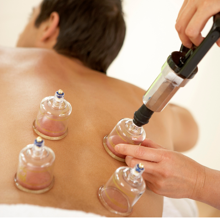 Cupping therapy image 2